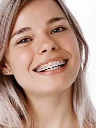Traditional Metal Braces