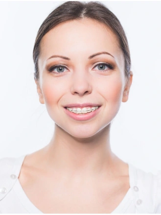 Clear Braces
