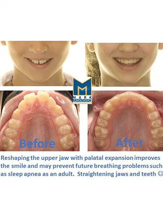 Palatal Expander
